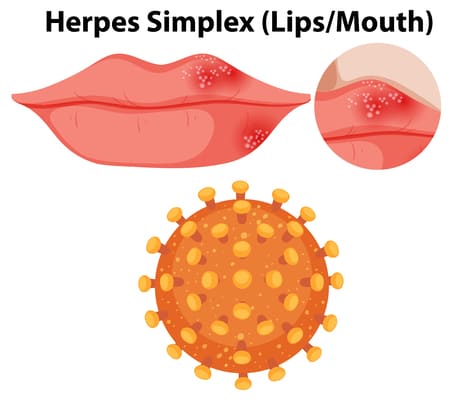 cold sore and oral herpes