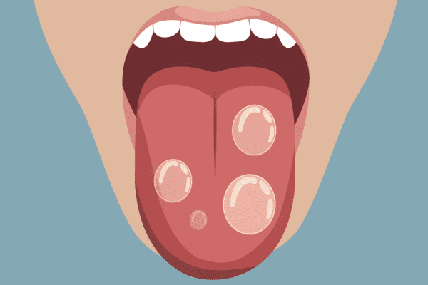 photo of herpes on the tongue